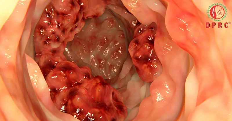 Bowel cancer