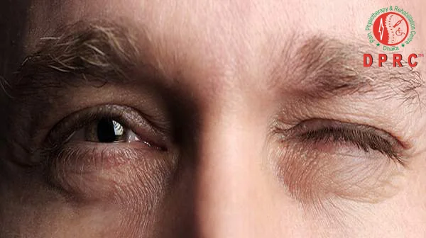 Blepharospasm
