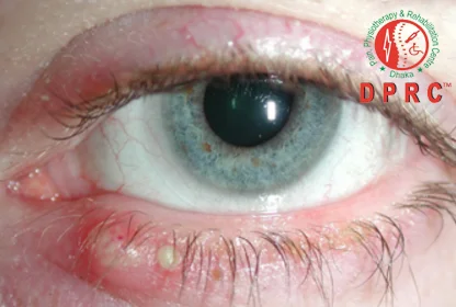 Lumps on or around the eyelids