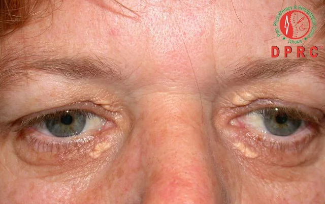 Xanthelasma
