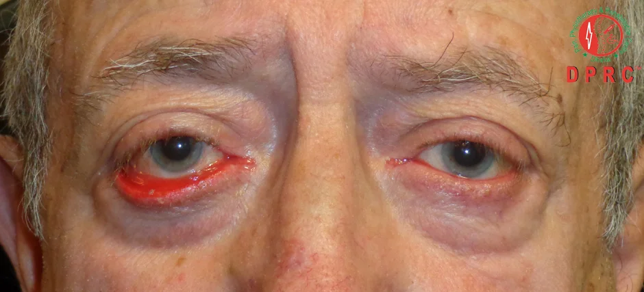 Ectropion