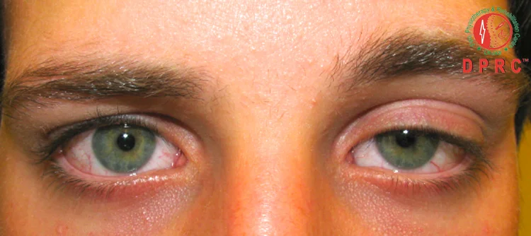 Hooded or droopy upper eyelids