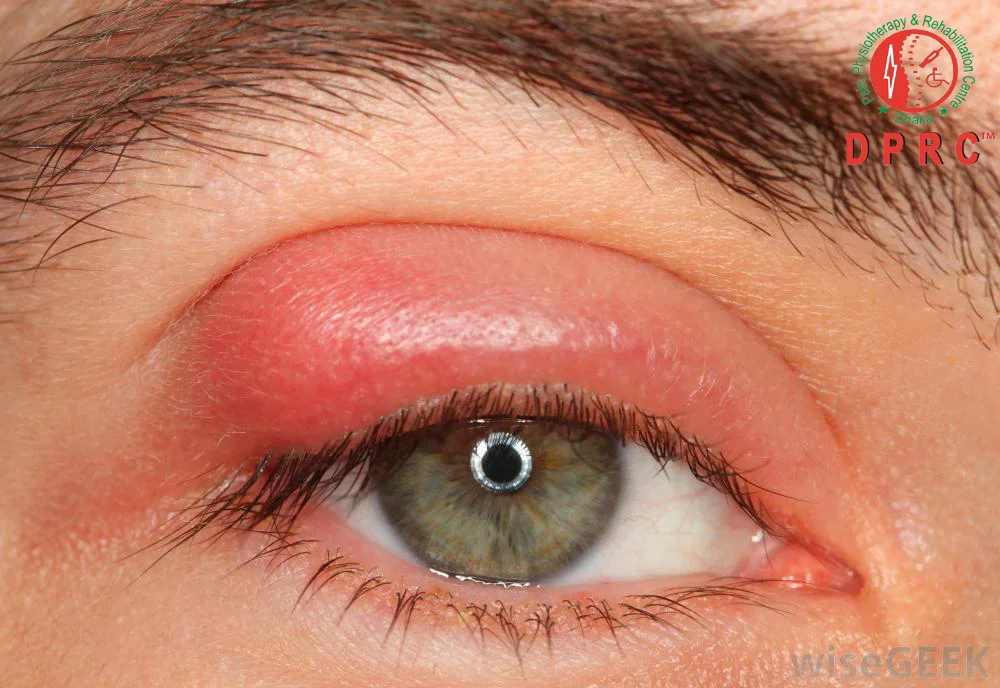 swollen-eyelid